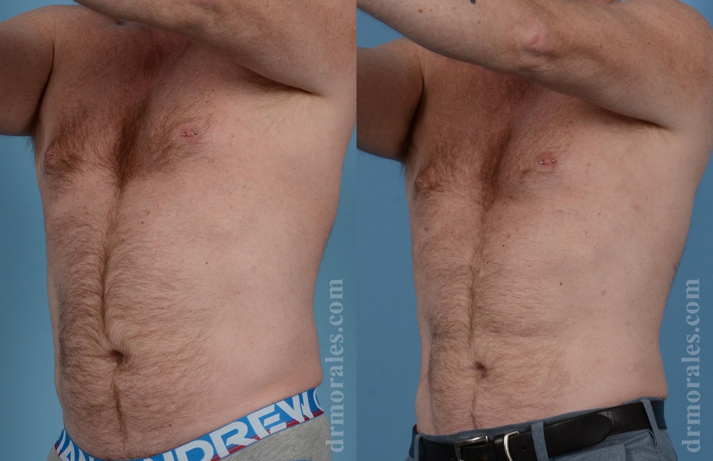 Before & After Male Body Contouring Case 1537 Left Oblique View in Houston, TX