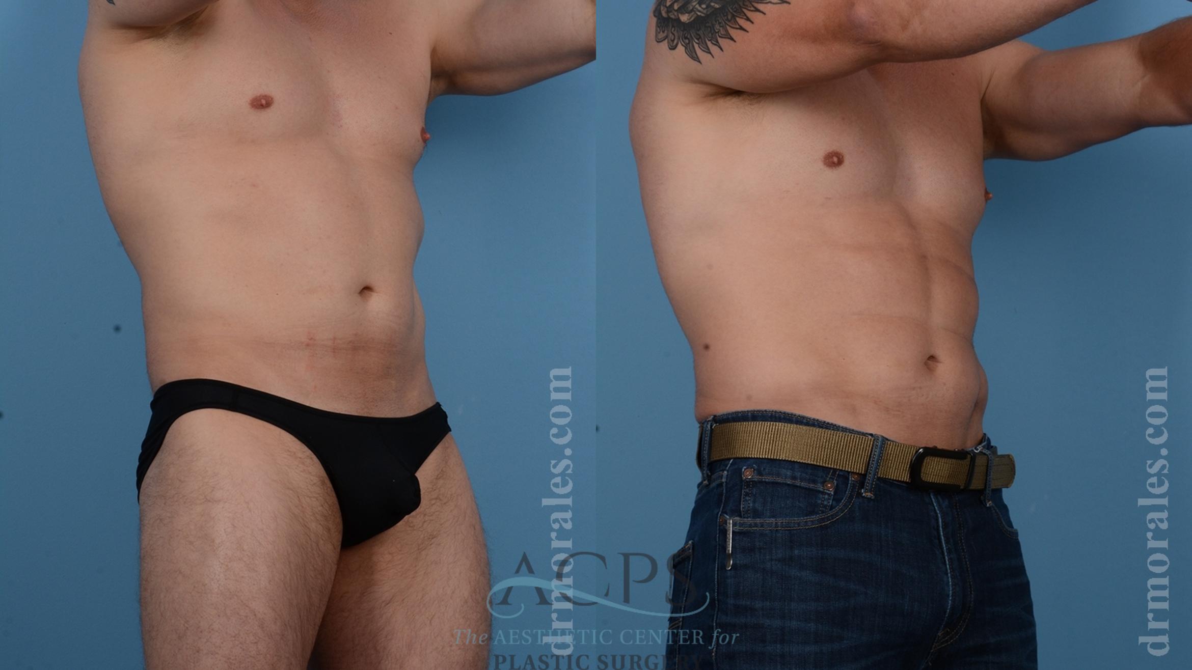 Before & After Abdominal Etching Case 1538 Right Oblique View in Houston, TX