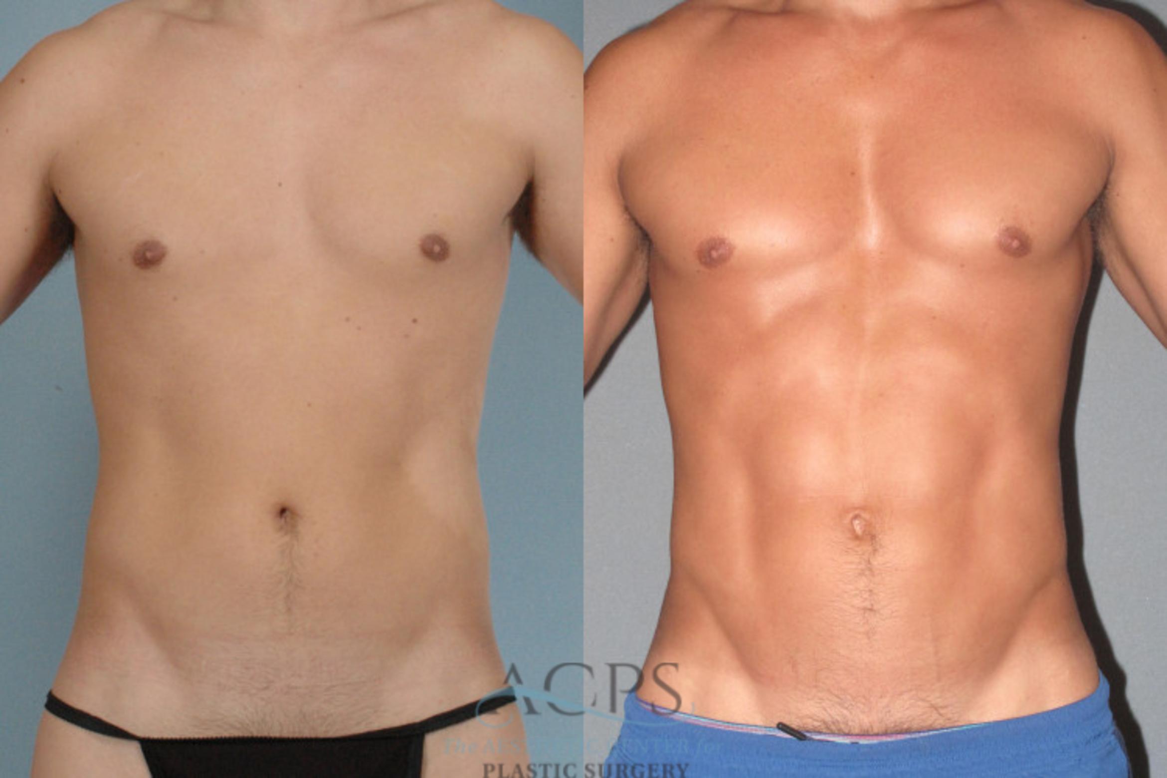 Before & After Abdominal Etching Case 782 Front View: View in Houston, TX