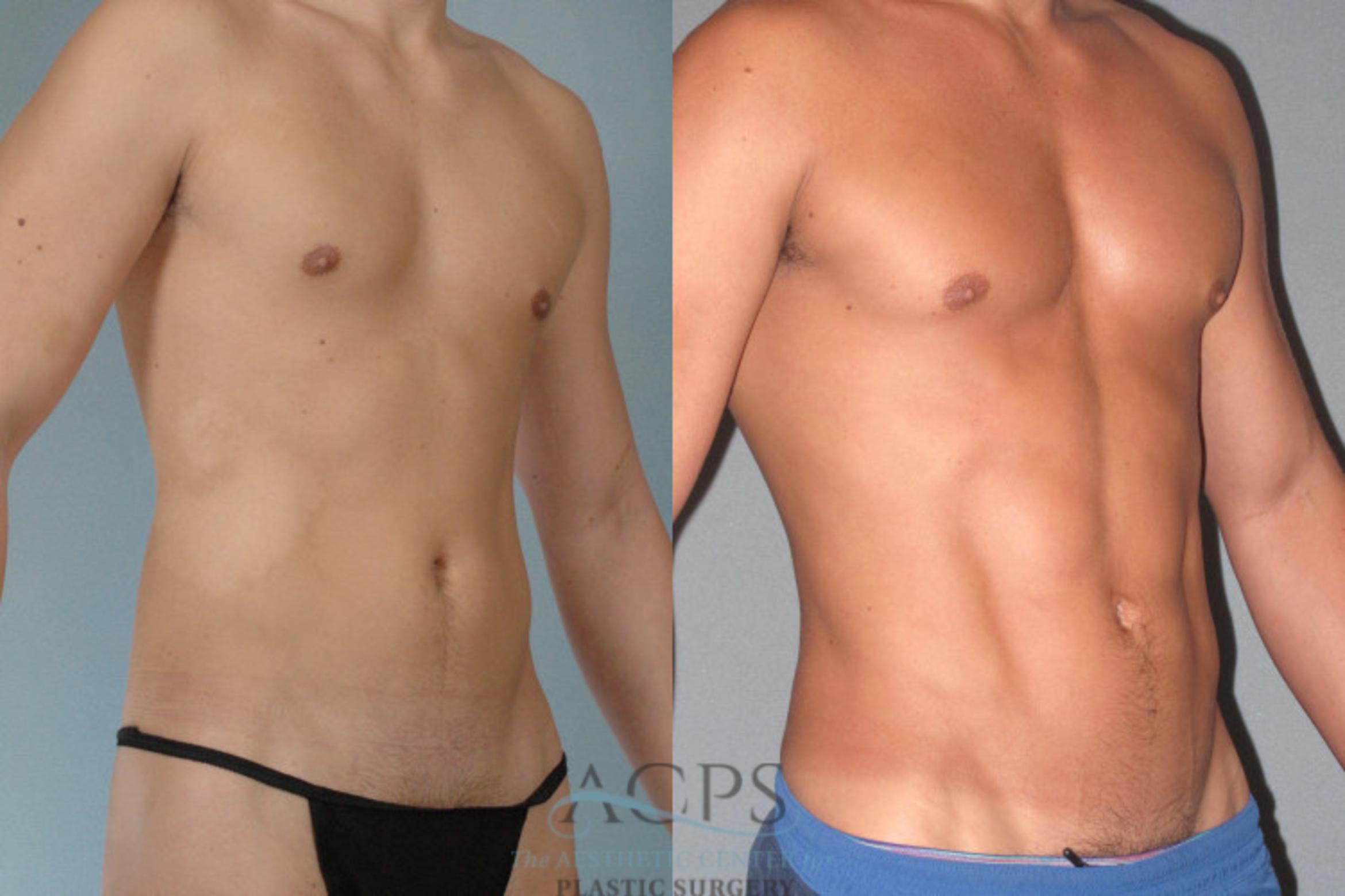 Before & After Abdominal Etching Case 782 Oblique View: View in Houston, TX