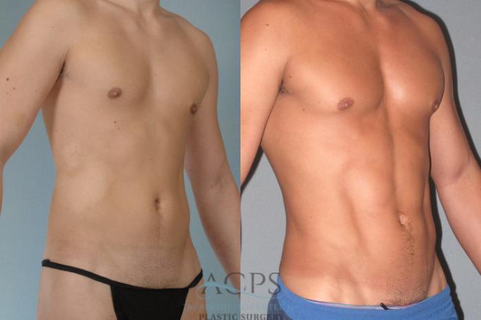 Before & After Abdominal Etching Case 782 Oblique View: View in Houston, TX