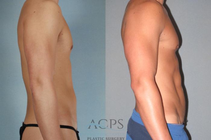 Before & After Abdominal Etching Case 782 Side View: View in Houston, TX