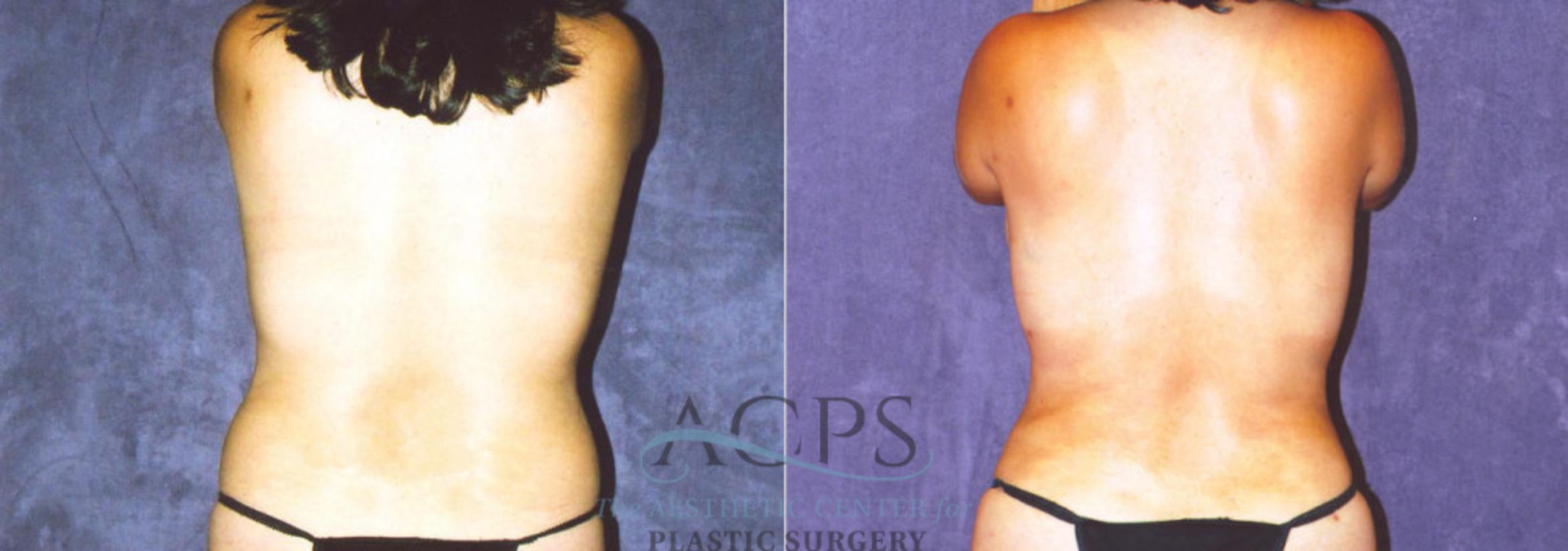 Before & After Abdominal Etching Case 783 Rear View: View in Houston, TX