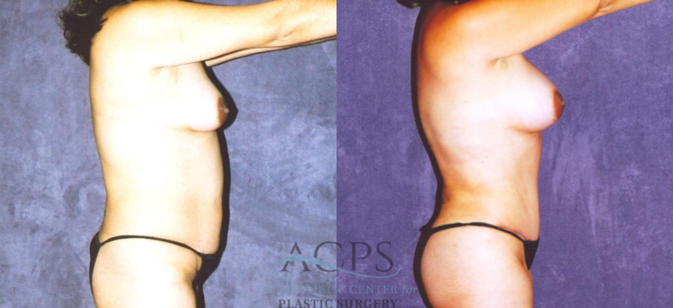 Before & After Abdominal Etching Case 783 Side View: View in Houston, TX