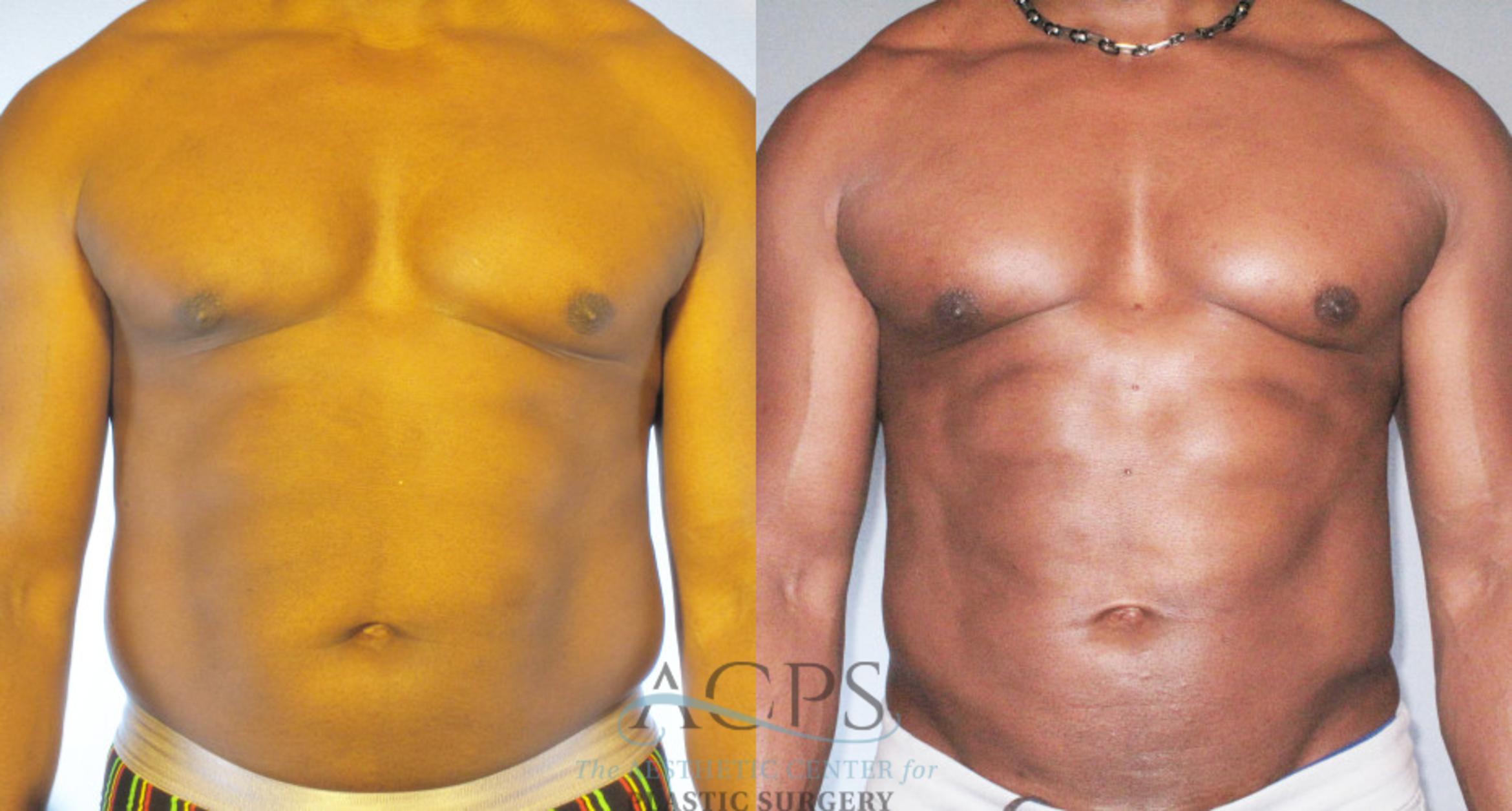 Before & After Abdominal Etching Case 784 Front View: View in Houston, TX