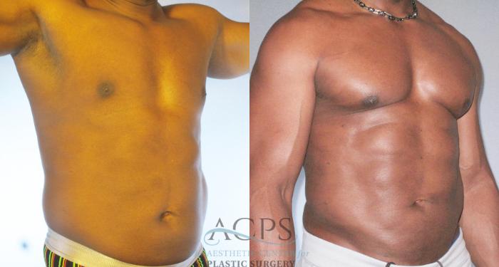 Before & After Abdominal Etching Case 784 Oblique View: View in Houston, TX
