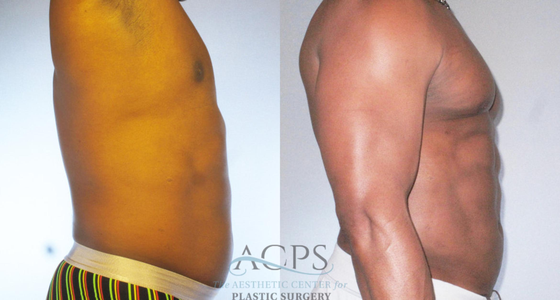 Before & After Abdominal Etching Case 784 Side View: View in Houston, TX