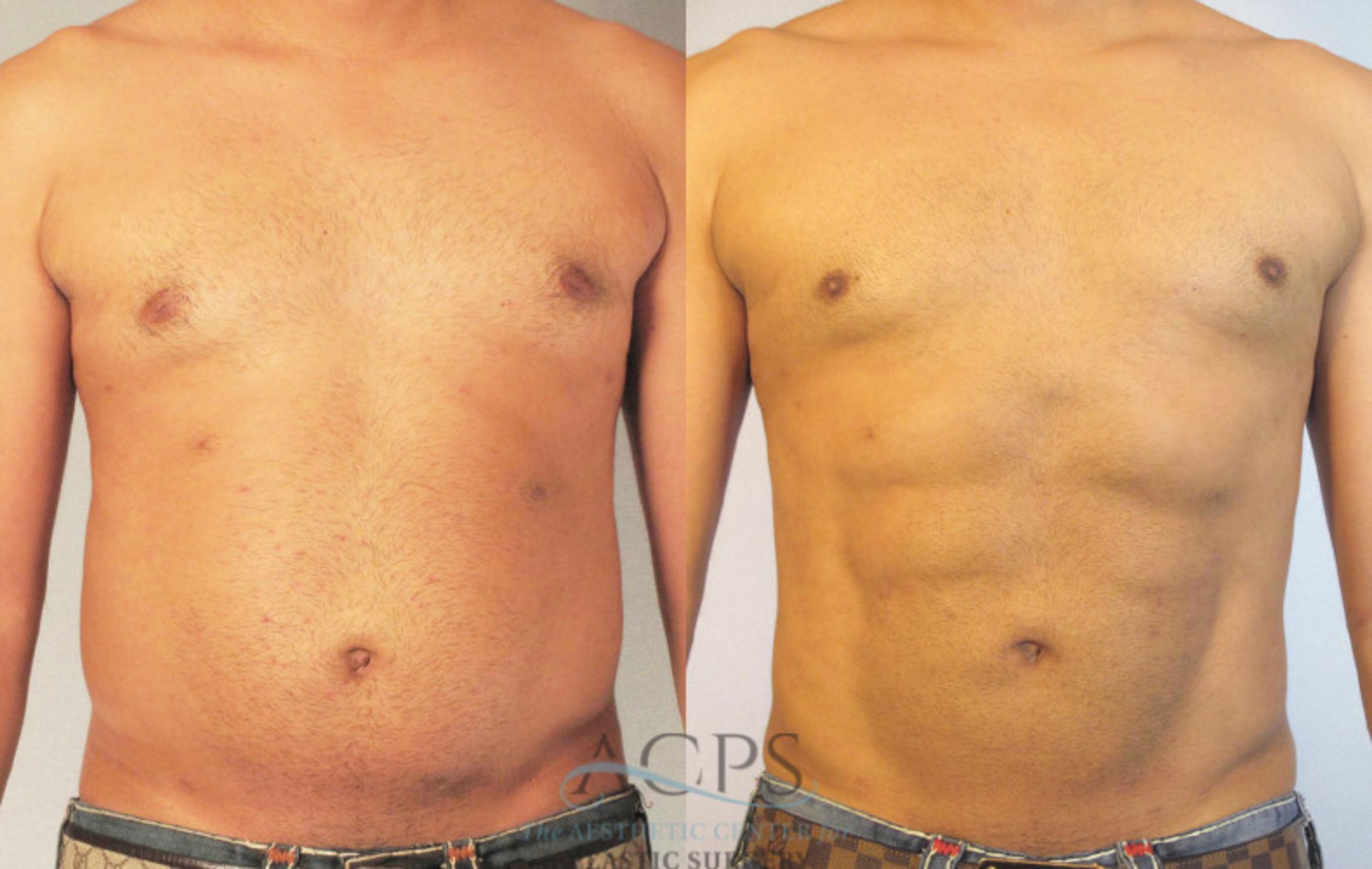 Before & After Abdominal Etching Case 785 Front View: View in Houston, TX