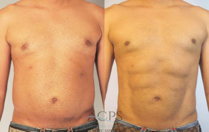 Before & After Abdominal Etching Case 785 Front View: View in Houston, TX