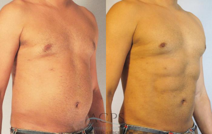 Before & After Abdominal Etching Case 785 Oblique View: View in Houston, TX