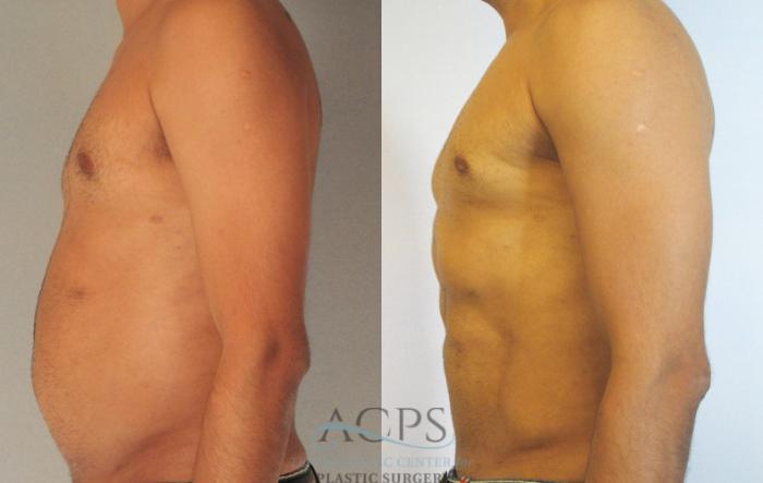 Before & After Abdominal Etching Case 785 Side View: View in Houston, TX