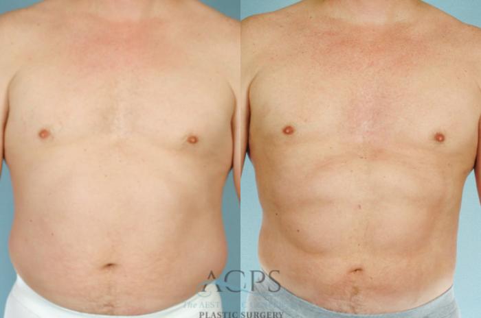 Before & After Abdominal Etching Case 786 Front View: View in Houston, TX