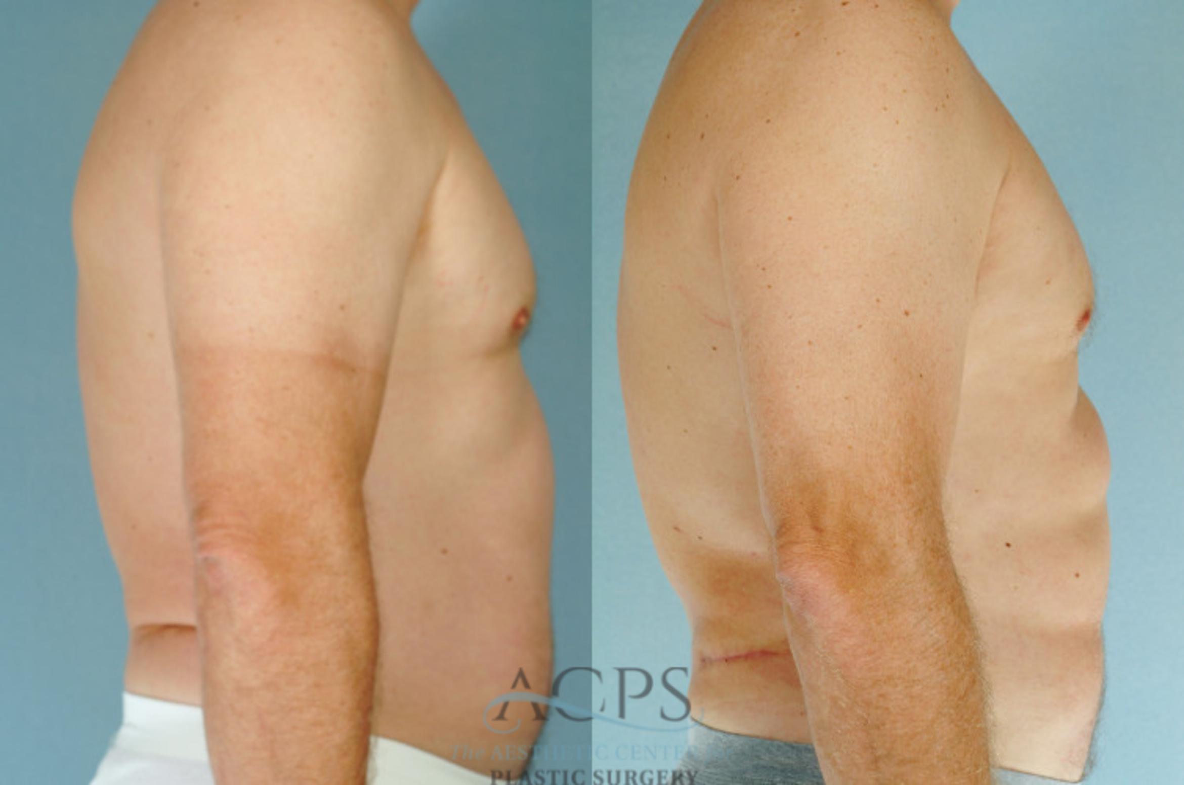 Before & After Abdominal Etching Case 786 Side View: View in Houston, TX