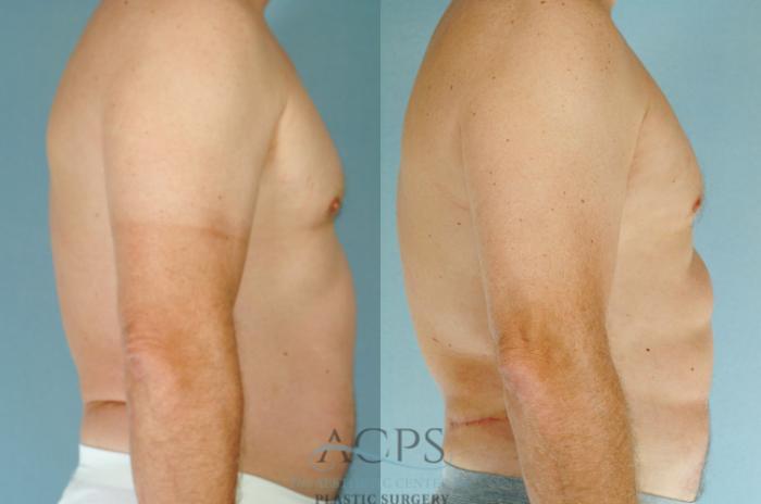 Before & After Abdominal Etching Case 786 Side View: View in Houston, TX