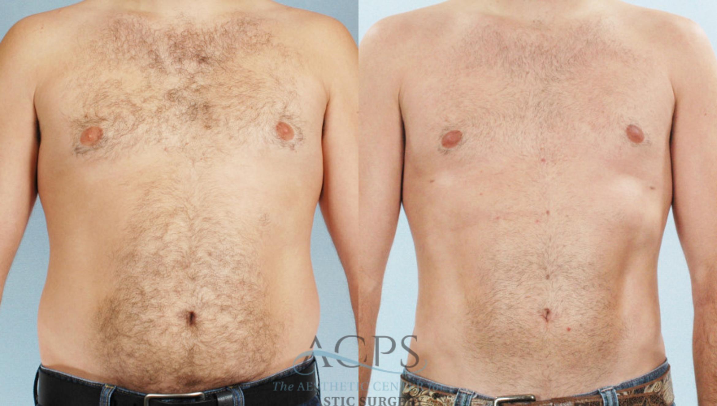 Before & After Abdominal Etching Case 787 Front View: View in Houston, TX