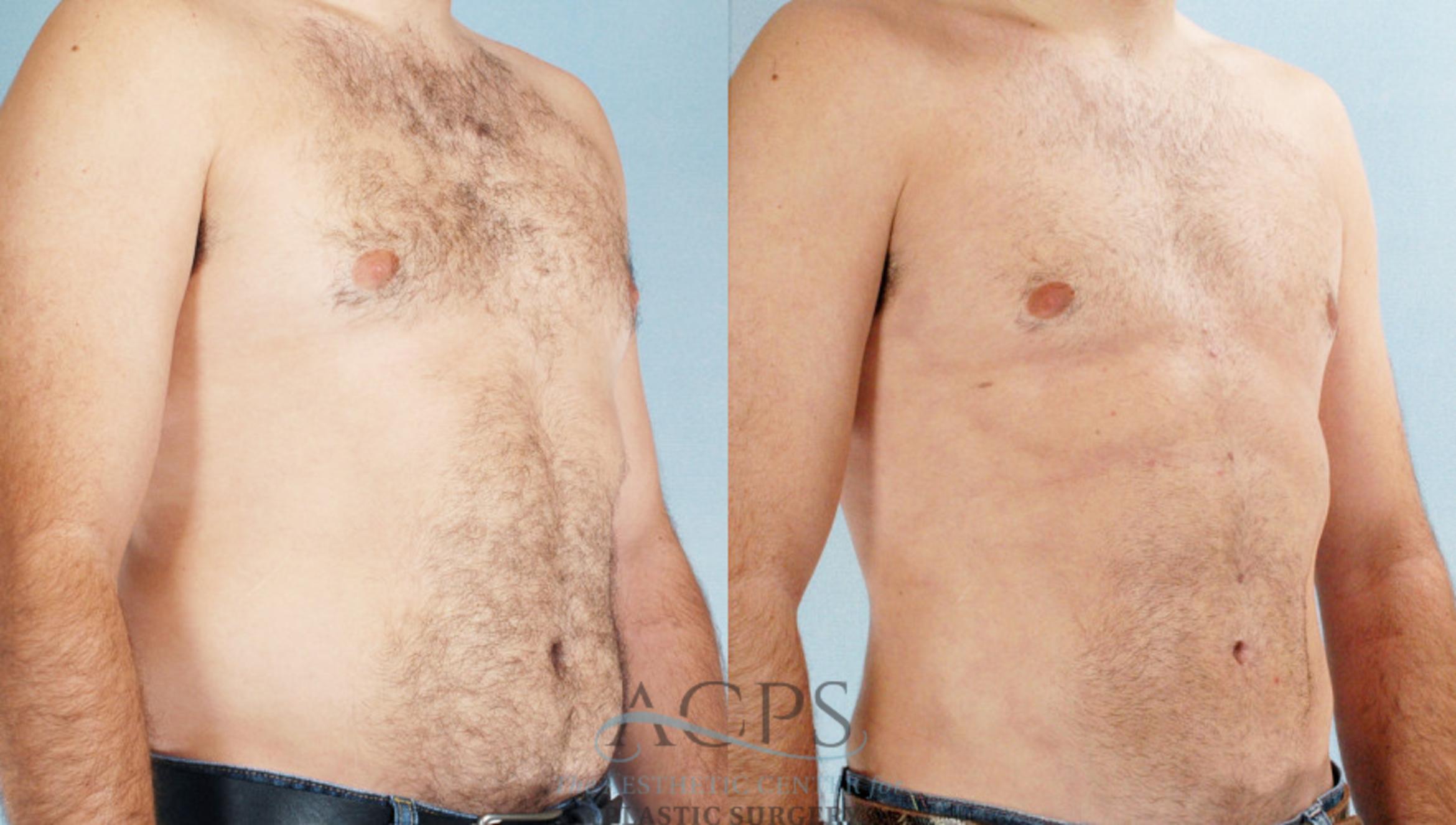 Before & After Abdominal Etching Case 787 Oblique View: View in Houston, TX