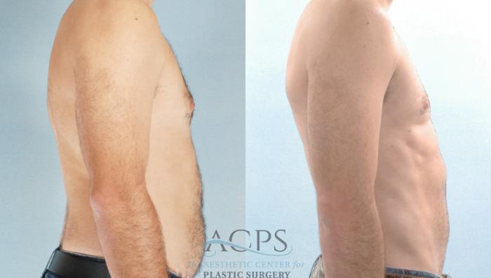Before & After Abdominal Etching Case 787 Side View: View in Houston, TX
