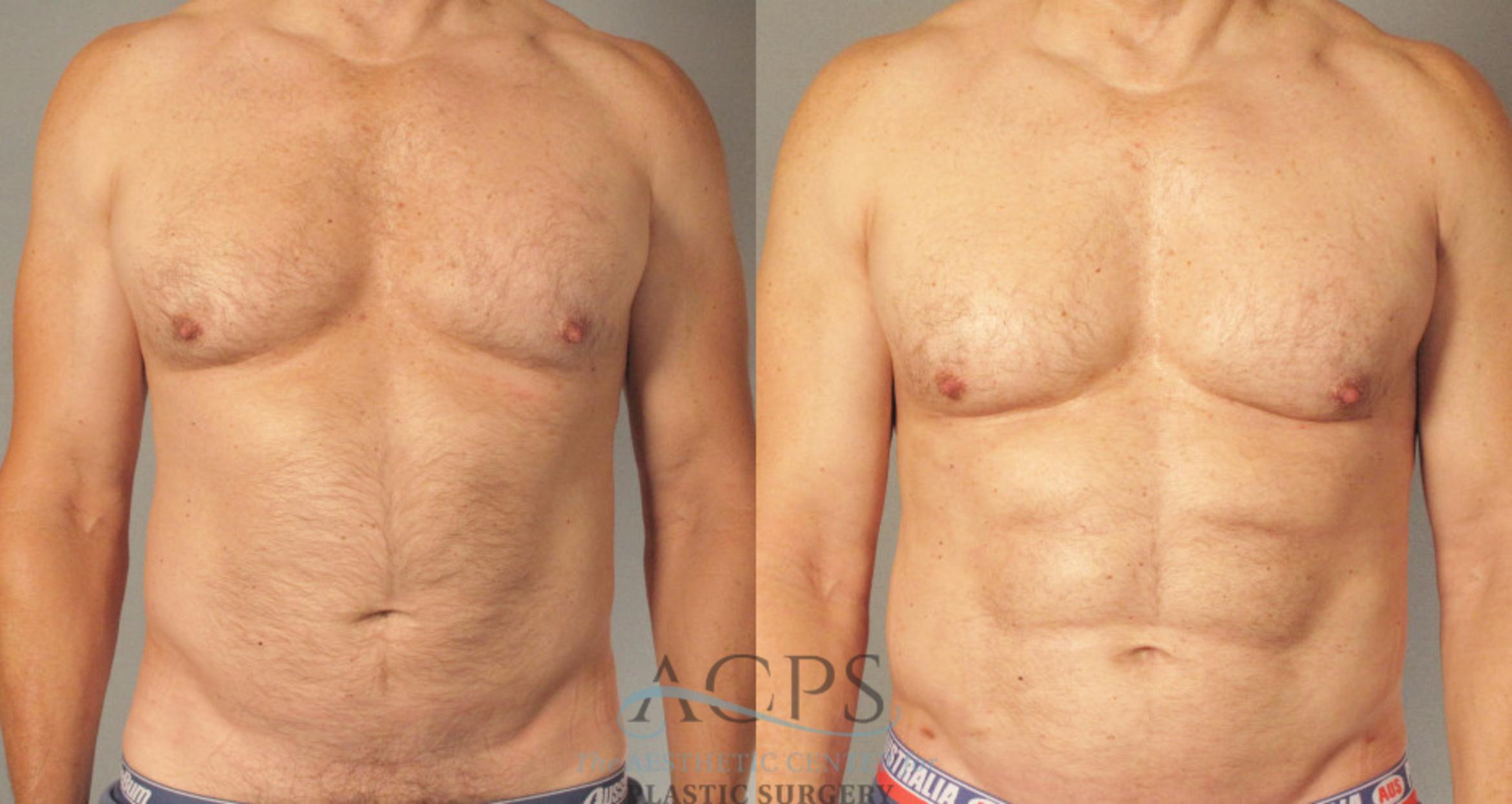 Before & After Abdominal Etching Case 788 Front View: View in Houston, TX