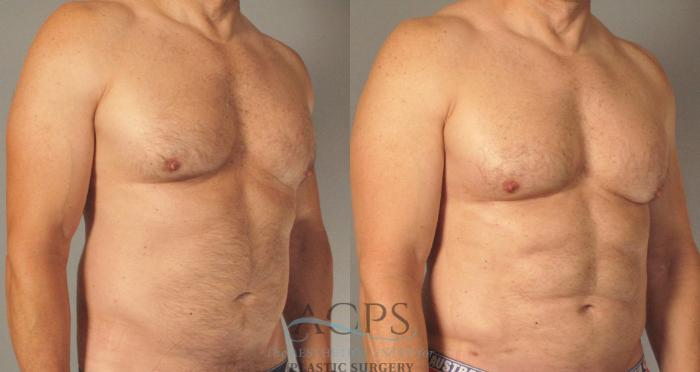 Before & After Abdominal Etching Case 788 Oblique View: View in Houston, TX