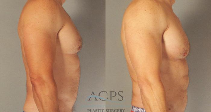 Before & After Abdominal Etching Case 788 Side View: View in Houston, TX