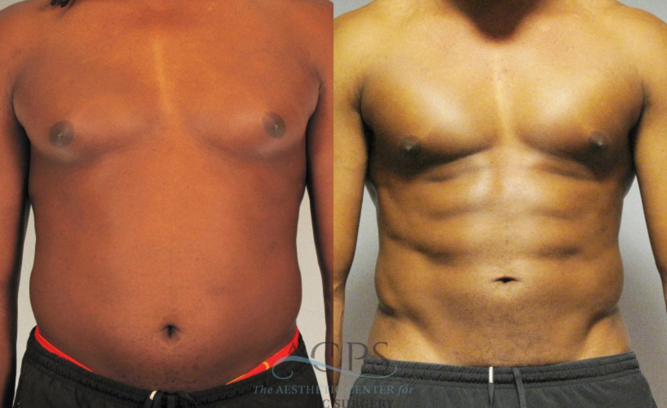 Before & After Abdominal Etching Case 789 Front View: View in Houston, TX