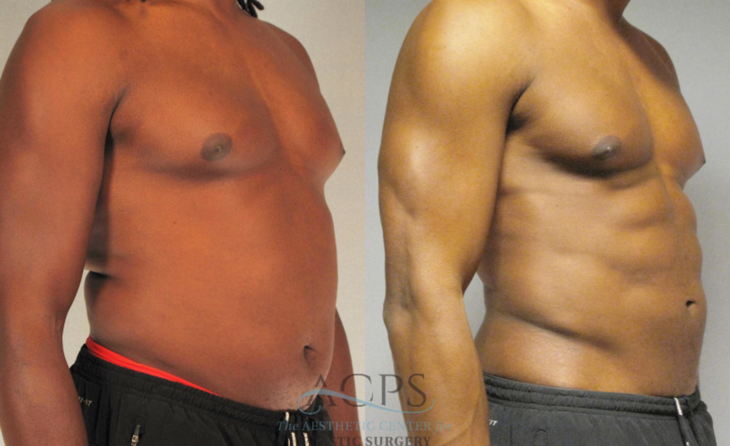 Before & After Abdominal Etching Case 789 Oblique View: View in Houston, TX