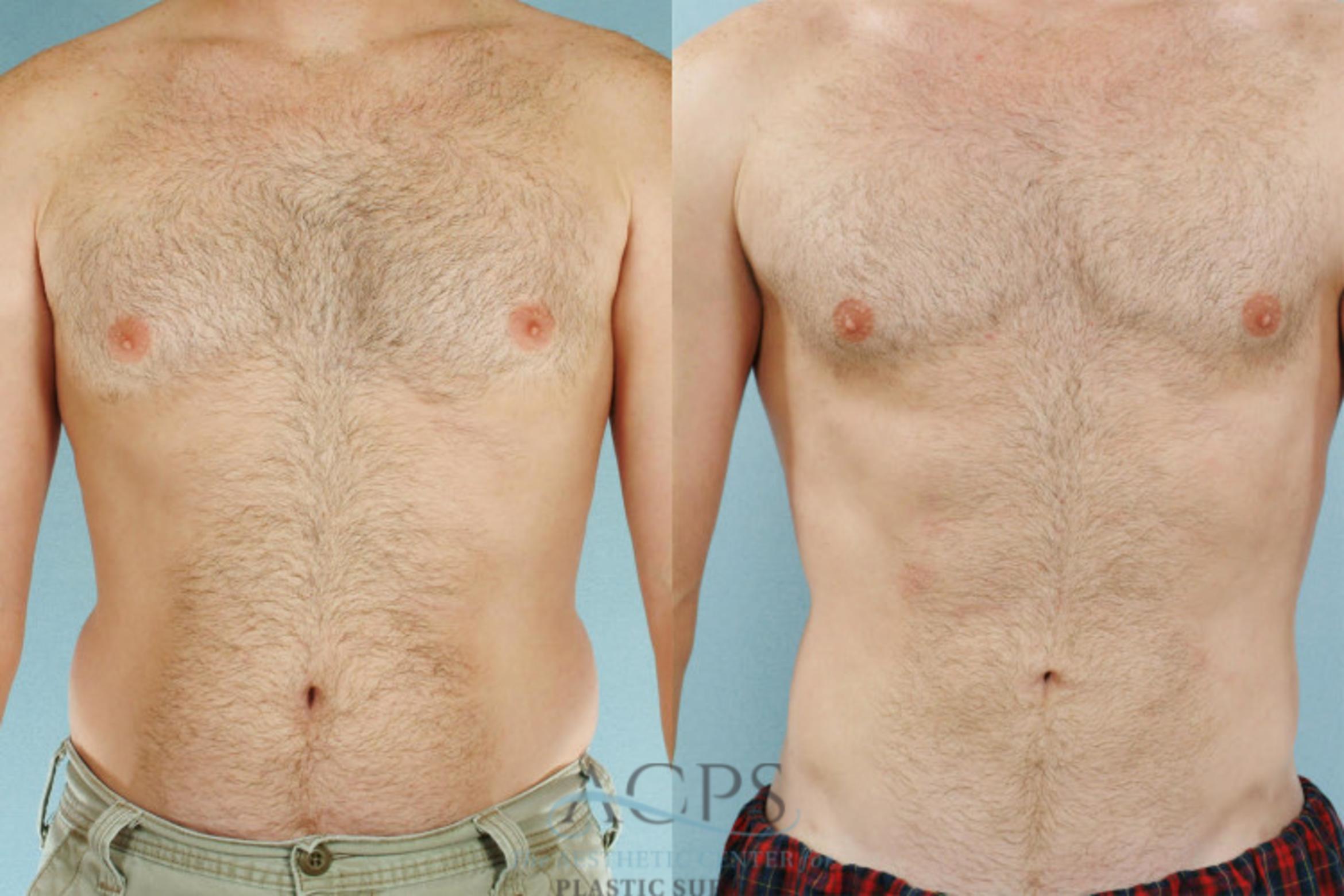 Before & After Abdominal Etching Case 790 Front View: View in Houston, TX