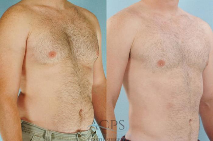 Before & After Abdominal Etching Case 790 Oblique View: View in Houston, TX