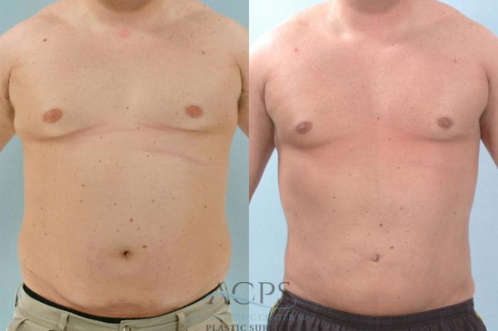 Before & After Abdominal Etching Case 791 Front View: View in Houston, TX