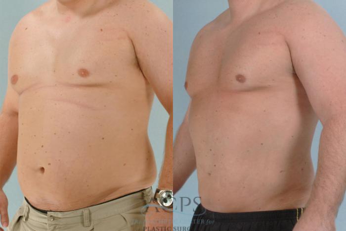 Before & After Abdominal Etching Case 791 Oblique View: View in Houston, TX