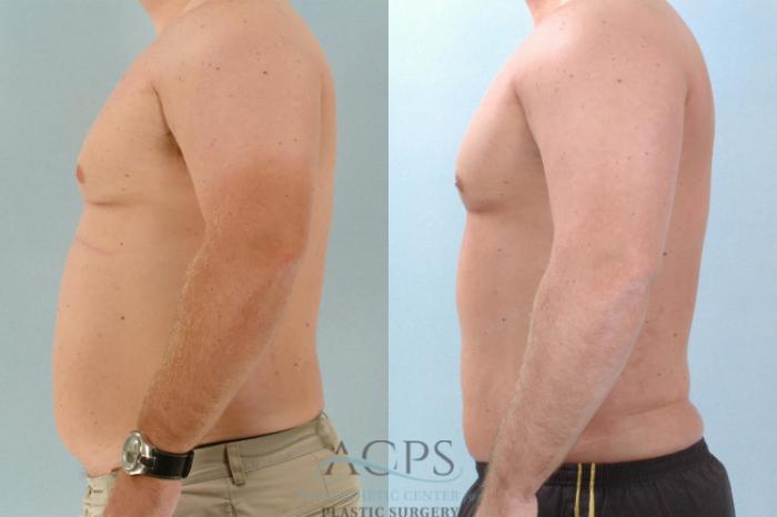 Before & After Abdominal Etching Case 791 Side View: View in Houston, TX