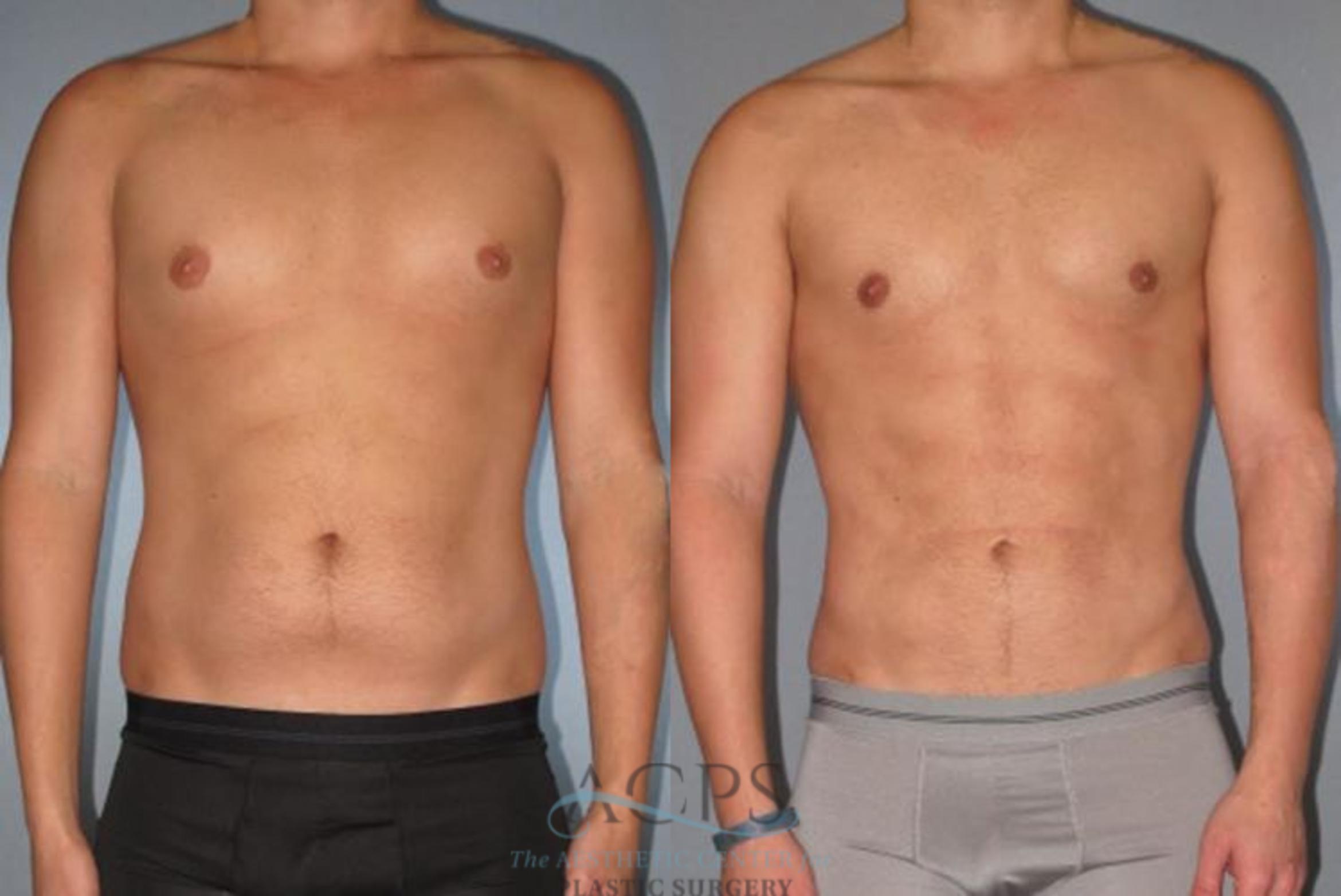 Before & After Abdominal Etching Case 792 Front View: View in Houston, TX