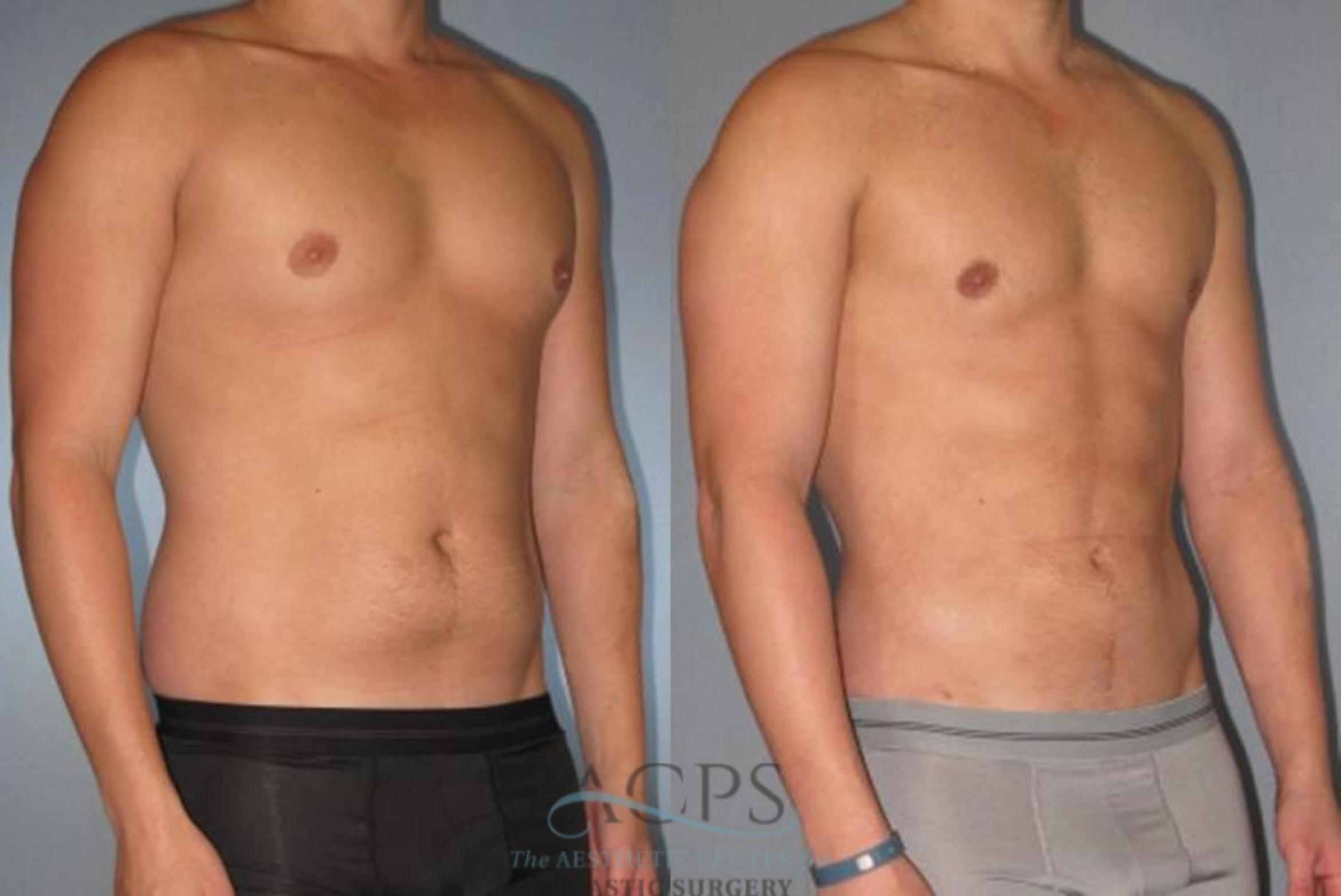 Before & After Abdominal Etching Case 792 Oblique View: View in Houston, TX