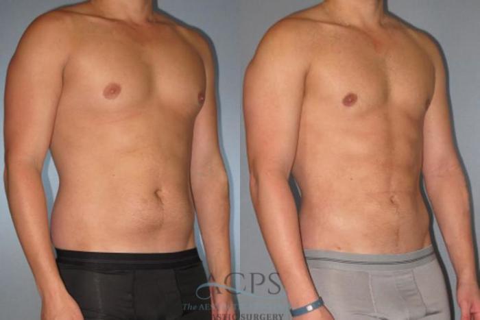 Before & After Abdominal Etching Case 792 Oblique View: View in Houston, TX