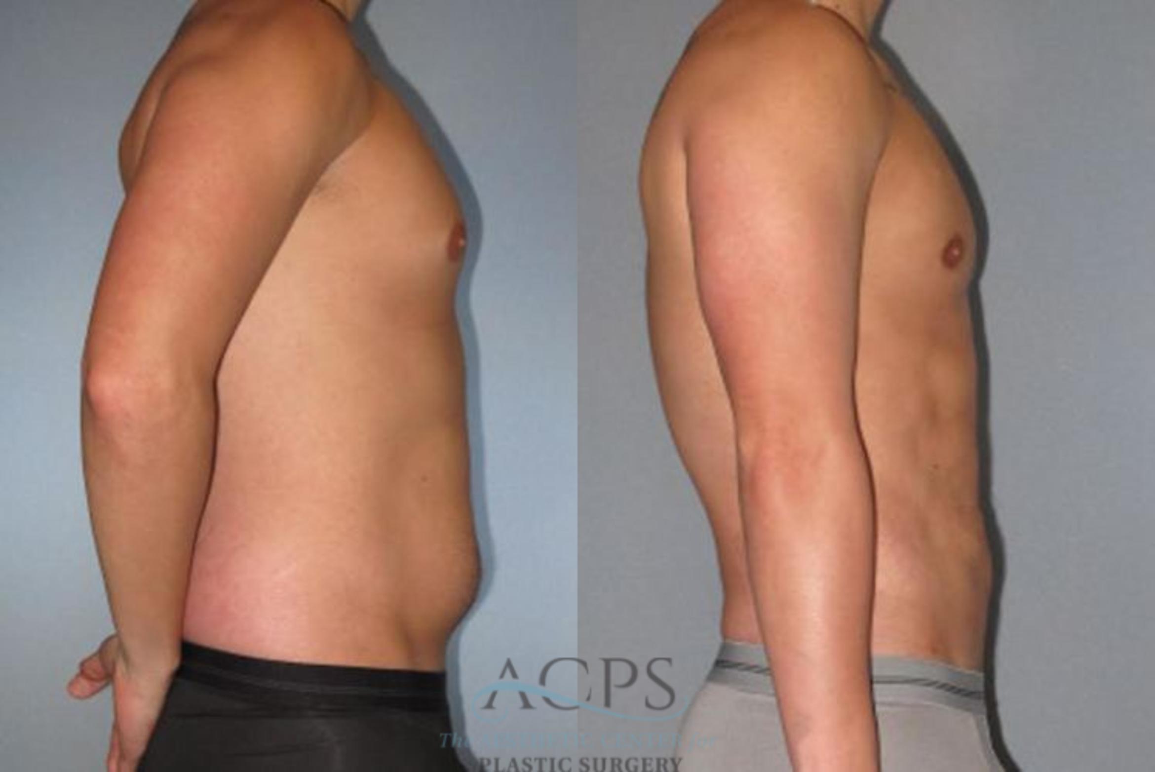 Before & After Abdominal Etching Case 792 Side View: View in Houston, TX
