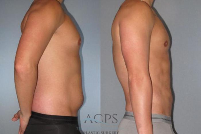 Before & After Abdominal Etching Case 792 Side View: View in Houston, TX