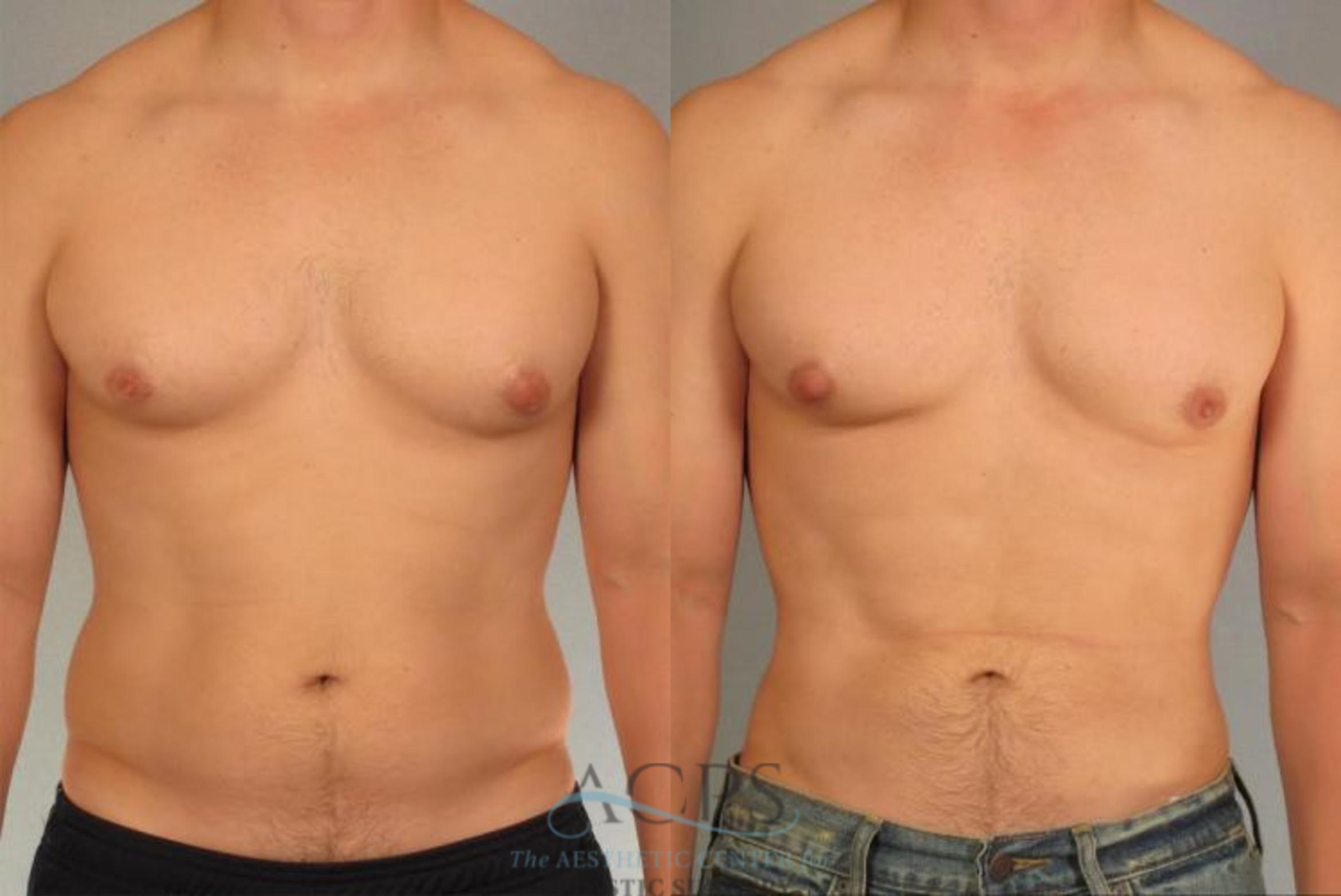 Before & After Abdominal Etching Case 793 Front View: View in Houston, TX
