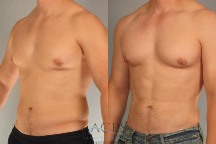 Before & After Abdominal Etching Case 793 Oblique View: View in Houston, TX