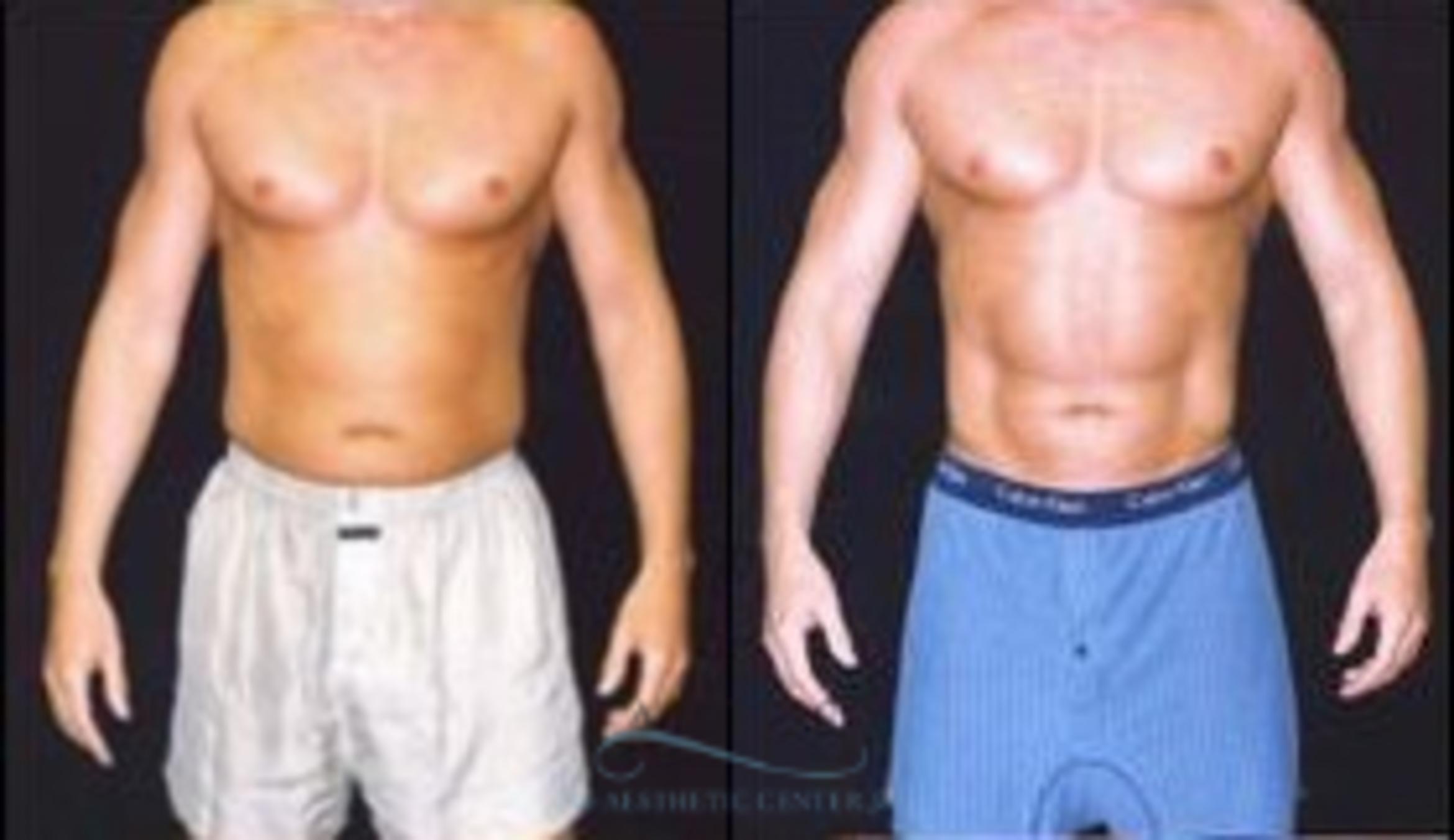 Before & After Abdominal Etching Case 794 Front View: View in Houston, TX
