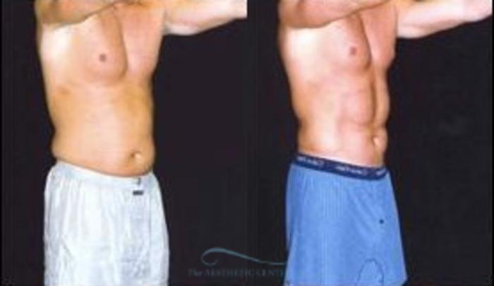 Before & After Abdominal Etching Case 794 Oblique View: View in Houston, TX