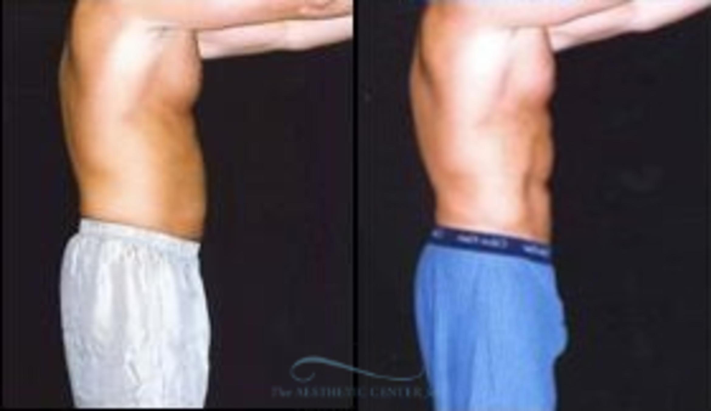 Before & After Abdominal Etching Case 794 Side View: View in Houston, TX