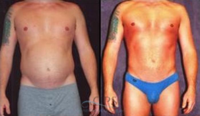 Before & After Abdominal Etching Case 795 Front View: View in Houston, TX
