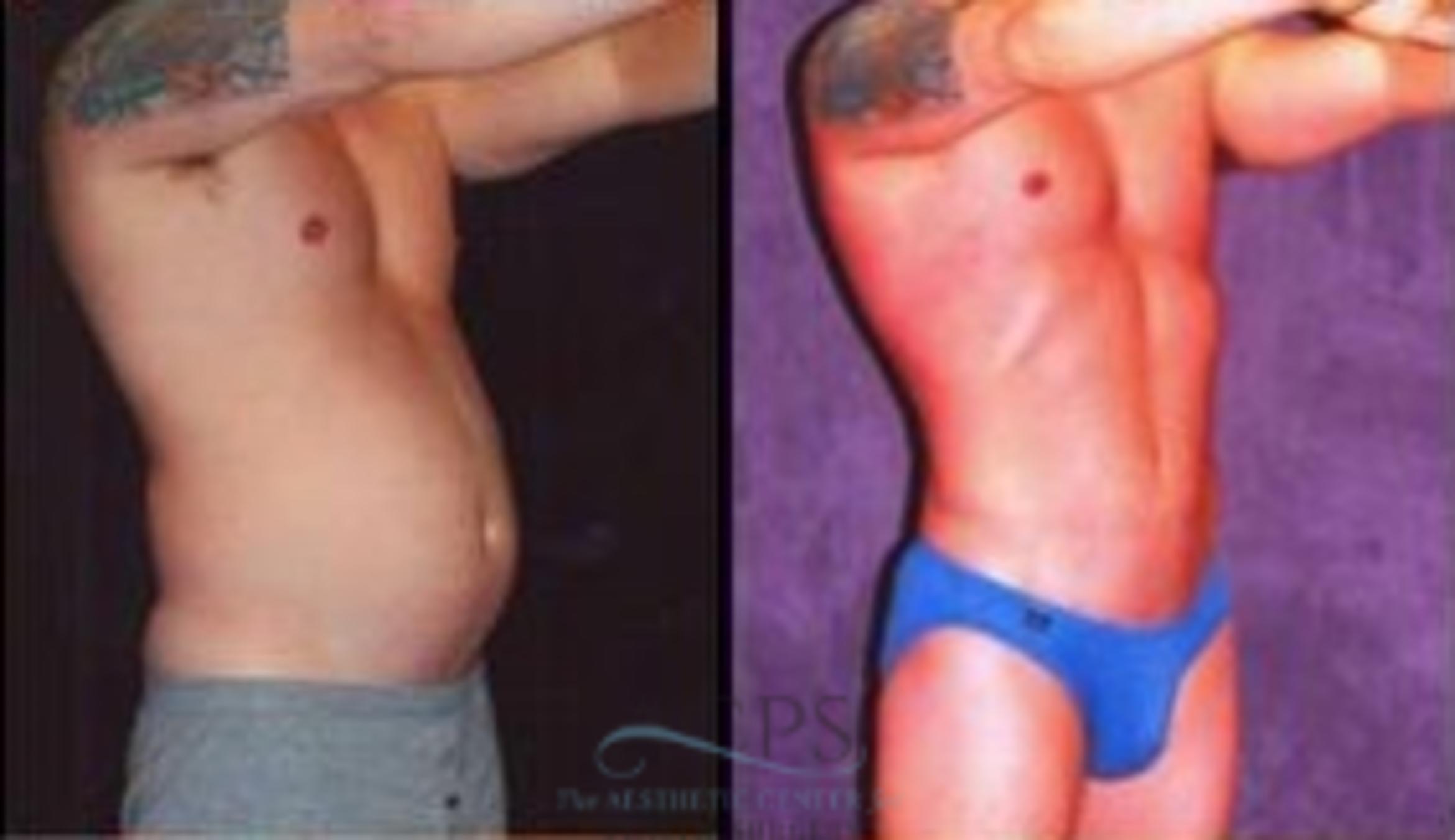 Before & After Abdominal Etching Case 795 Oblique View: View in Houston, TX