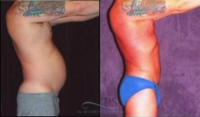 Before & After Abdominal Etching Case 795 Side View: View in Houston, TX
