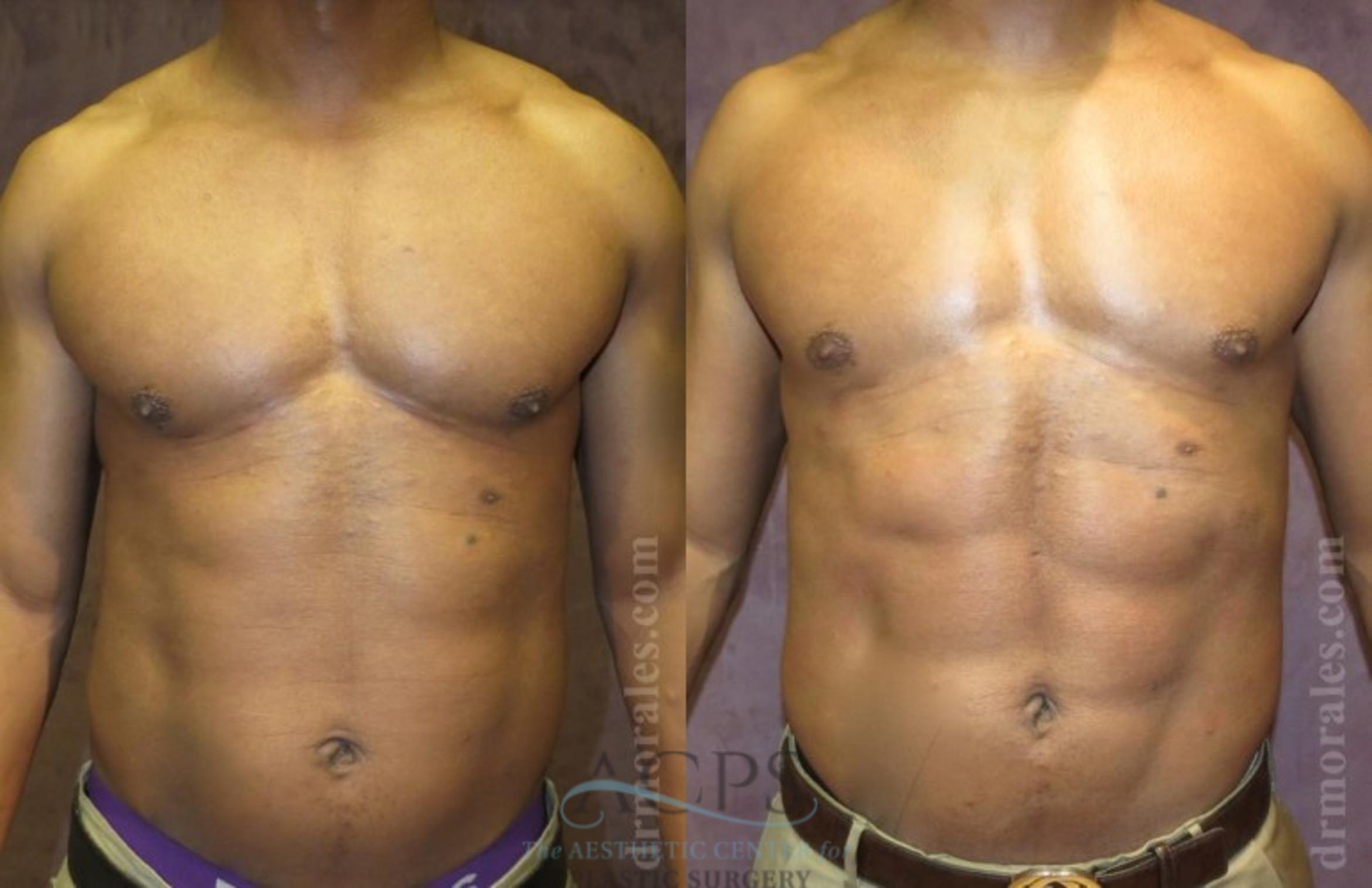 Before & After Abdominal Etching Case 796 Front View: View in Houston, TX