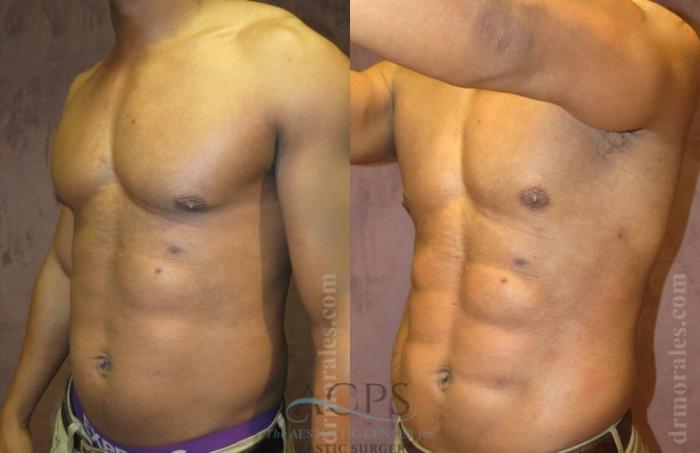 Before & After Abdominal Etching Case 796 Oblique View: View in Houston, TX