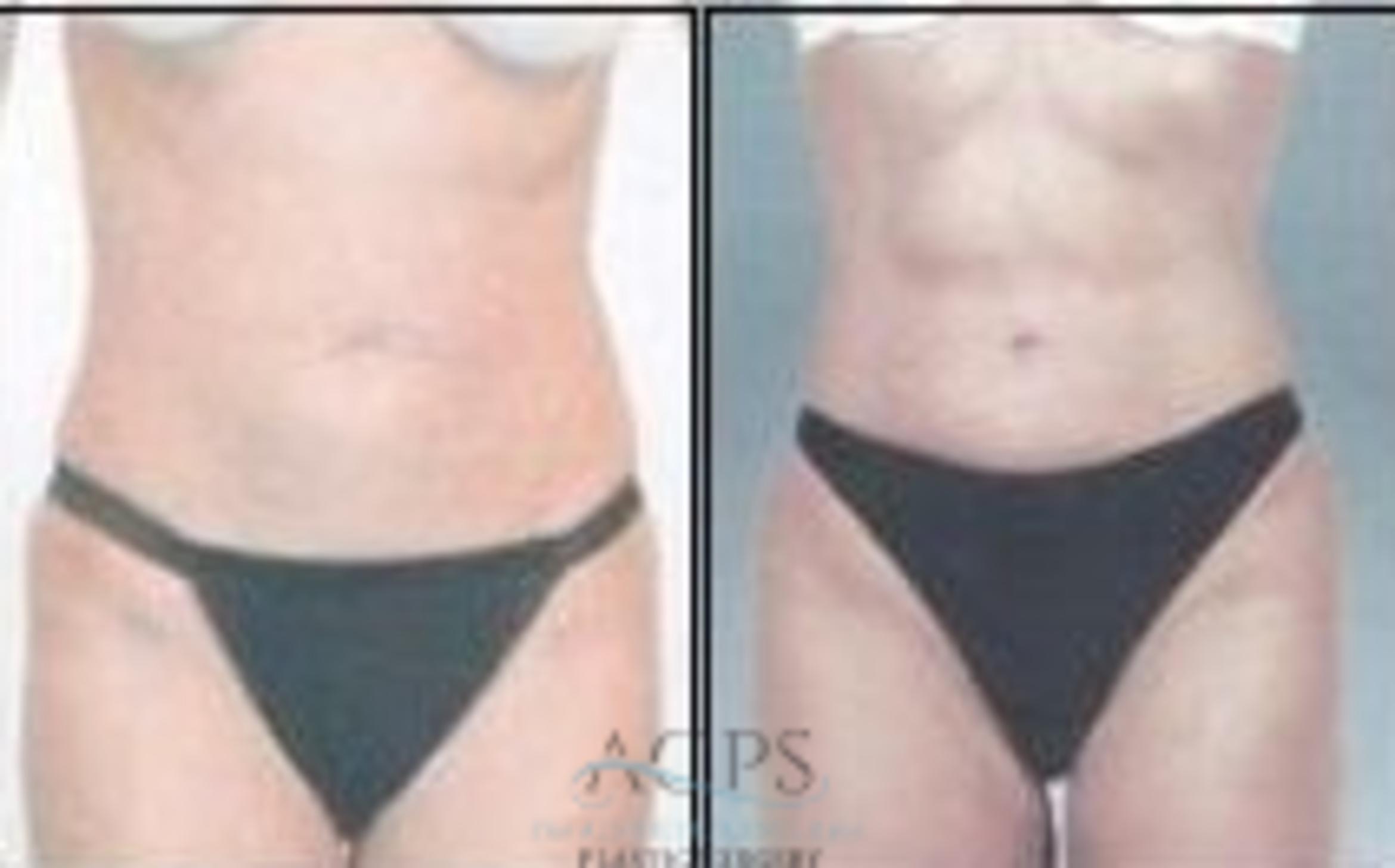 Before & After Abdominal Etching Case 797 Front View: View in Houston, TX