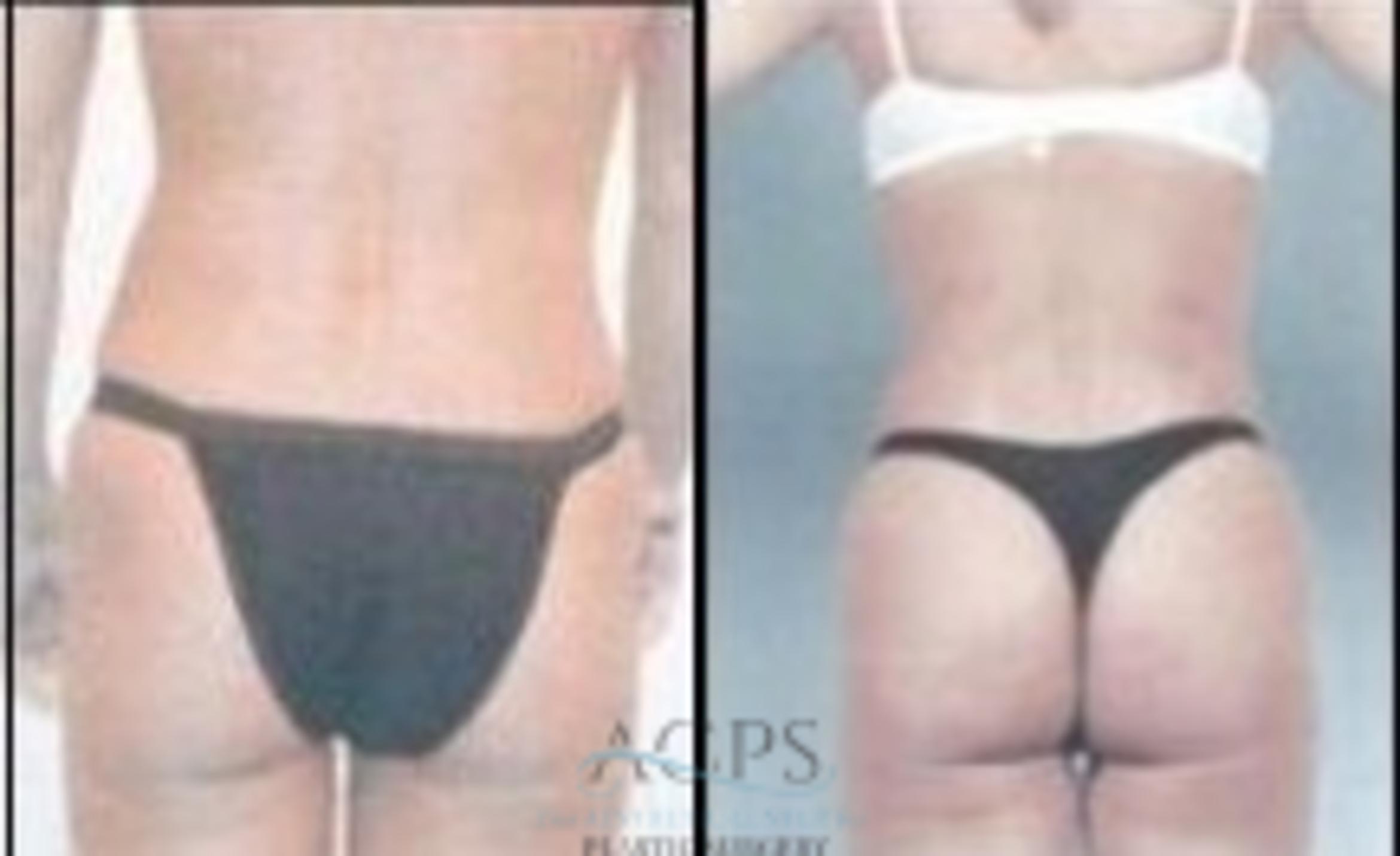 Before & After Abdominal Etching Case 797 Rear View: View in Houston, TX