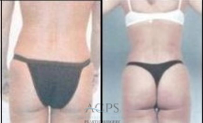 Before & After Abdominal Etching Case 797 Rear View: View in Houston, TX