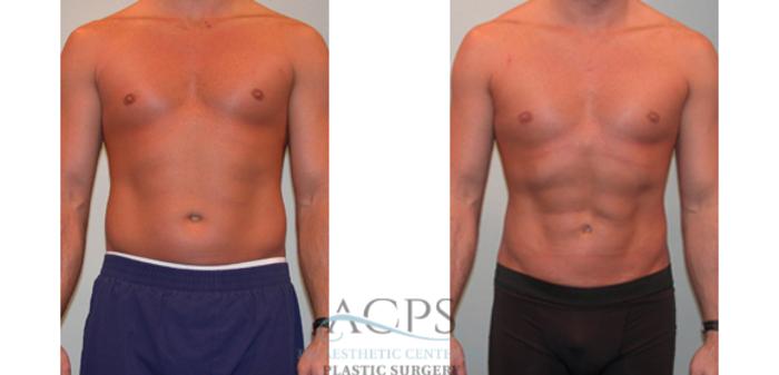 Before & After Abdominal Etching Case 798 Front View: View in Houston, TX